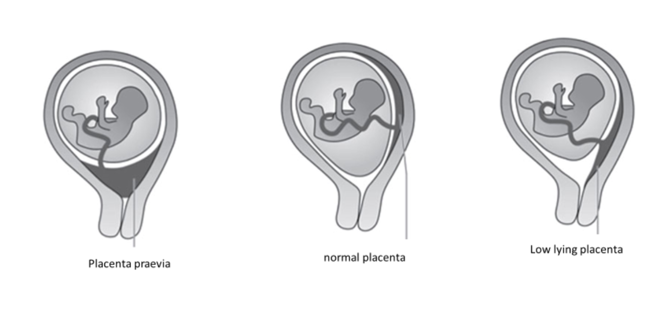 Placenta Praevia and Placenta Accreta Obs And Gynae